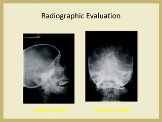 Radiographic Evaluation
Lateral skull Water’s View
 