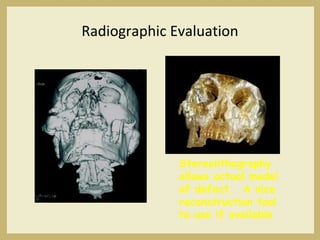 Radiographic Evaluation
Stereolithography
allows actual model
of defect. A nice
reconstruction tool
to use if available
 