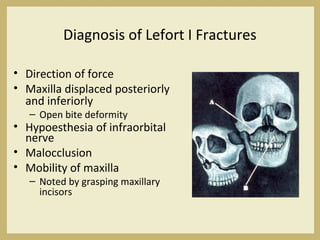 Diagnosis of Lefort I Fractures
• Direction of force
• Maxilla displaced posteriorly
and inferiorly
– Open bite deformity
• Hypoesthesia of infraorbital
nerve
• Malocclusion
• Mobility of maxilla
– Noted by grasping maxillary
incisors
 