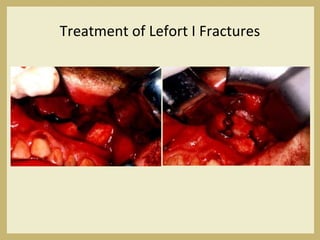 Treatment of Lefort I Fractures
 