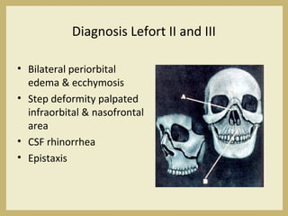 Diagnosis Lefort II and III
• Bilateral periorbital
edema & ecchymosis
• Step deformity palpated
infraorbital & nasofrontal
area
• CSF rhinorrhea
• Epistaxis
 