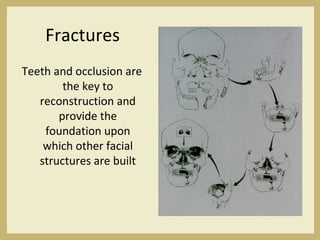 Fractures
Teeth and occlusion are
the key to
reconstruction and
provide the
foundation upon
which other facial
structures are built
 