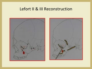 Lefort II & III Reconstruction
 