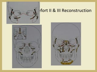 Lefort II & III Reconstruction
 