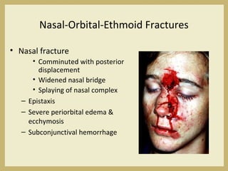 Nasal-Orbital-Ethmoid Fractures
• Nasal fracture
• Comminuted with posterior
displacement
• Widened nasal bridge
• Splaying of nasal complex
– Epistaxis
– Severe periorbital edema &
ecchymosis
– Subconjunctival hemorrhage
 