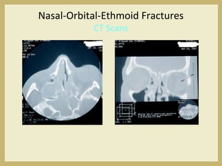Nasal-Orbital-Ethmoid Fractures
CT Scans
 