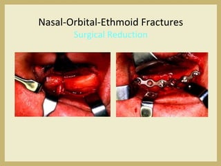 Nasal-Orbital-Ethmoid Fractures
Surgical Reduction
 