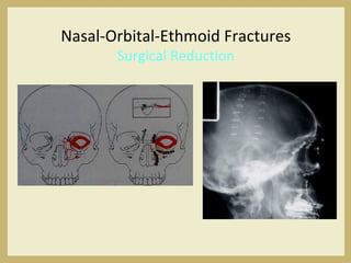 Nasal-Orbital-Ethmoid Fractures
Surgical Reduction
 