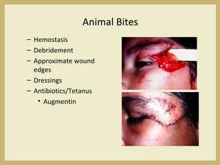 Animal Bites
– Hemostasis
– Debridement
– Approximate wound
edges
– Dressings
– Antibiotics/Tetanus
• Augmentin
 