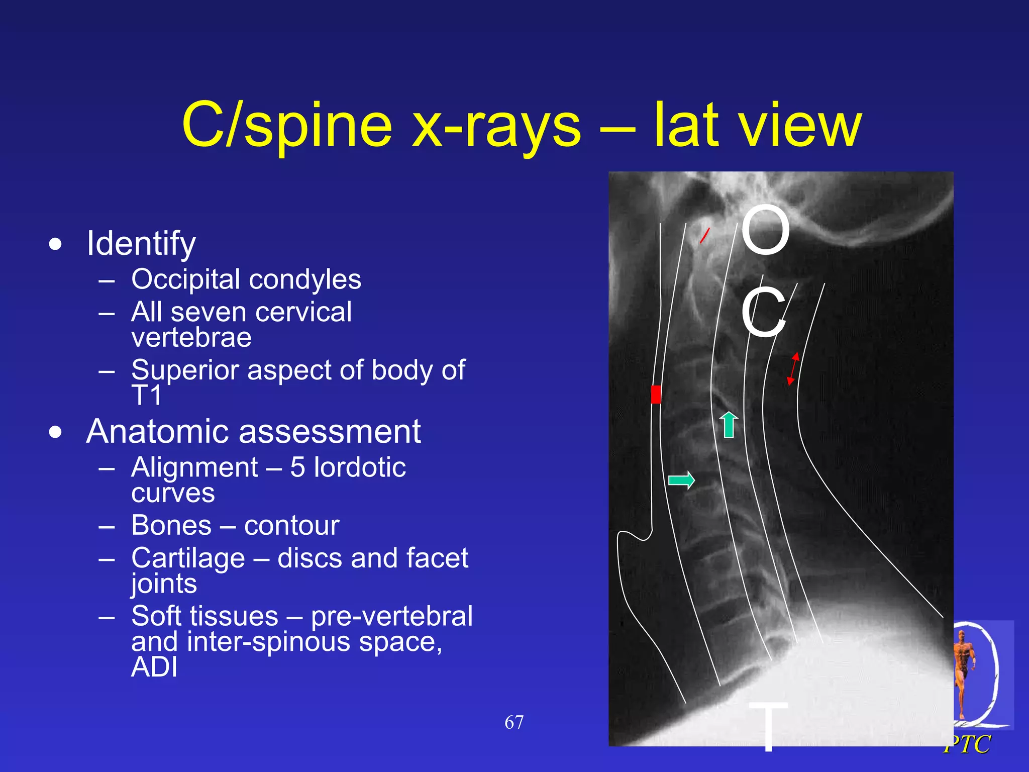 C/ spine  x-rays – lat view Identify Occipital condyles All seven cervical vertebrae Superior aspect of body of T1 Anatomic assessment Alignment – 5 lordotic curves Bones – contour Cartilage – discs and facet joints Soft tissues – pre-vertebral and inter-spinous space, ADI OC T1 