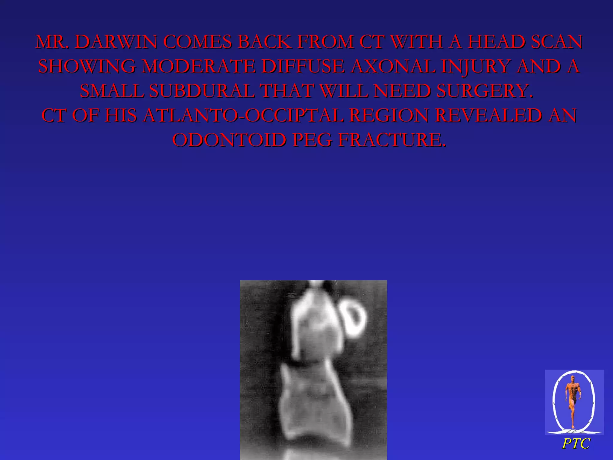 MR. DARWIN COMES BACK FROM CT WITH A HEAD SCAN SHOWING MODERATE DIFFUSE AXONAL INJURY AND A SMALL SUBDURAL THAT WILL NEED SURGERY.  CT OF HIS ATLANTO-OCCIPTAL REGION REVEALED AN ODONTOID PEG FRACTURE. 