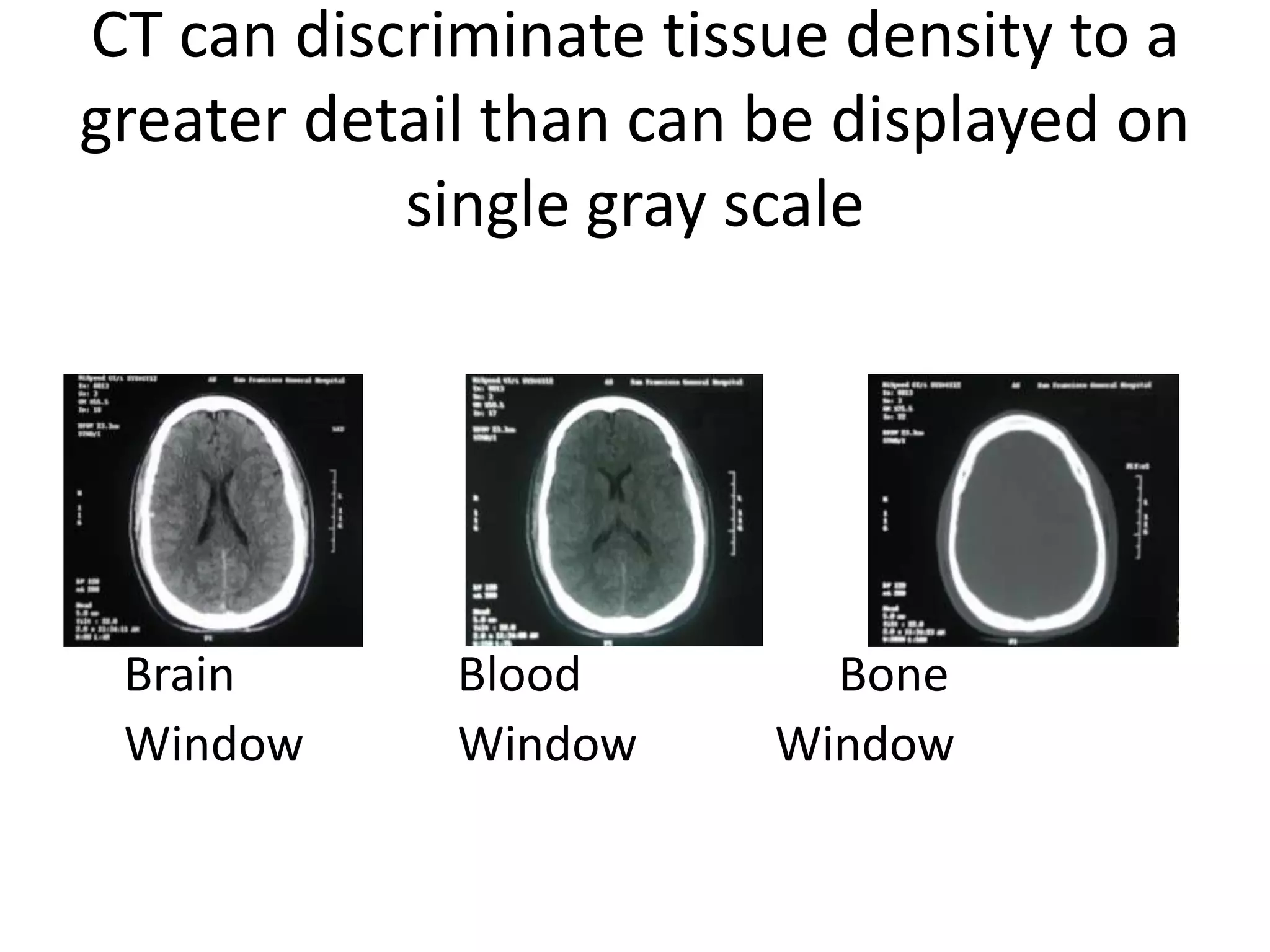 CT can discriminate tissue density to a greater detail than can be displayed on single gray scale	Brain 				Blood 				Bone	Window			Window			Window			