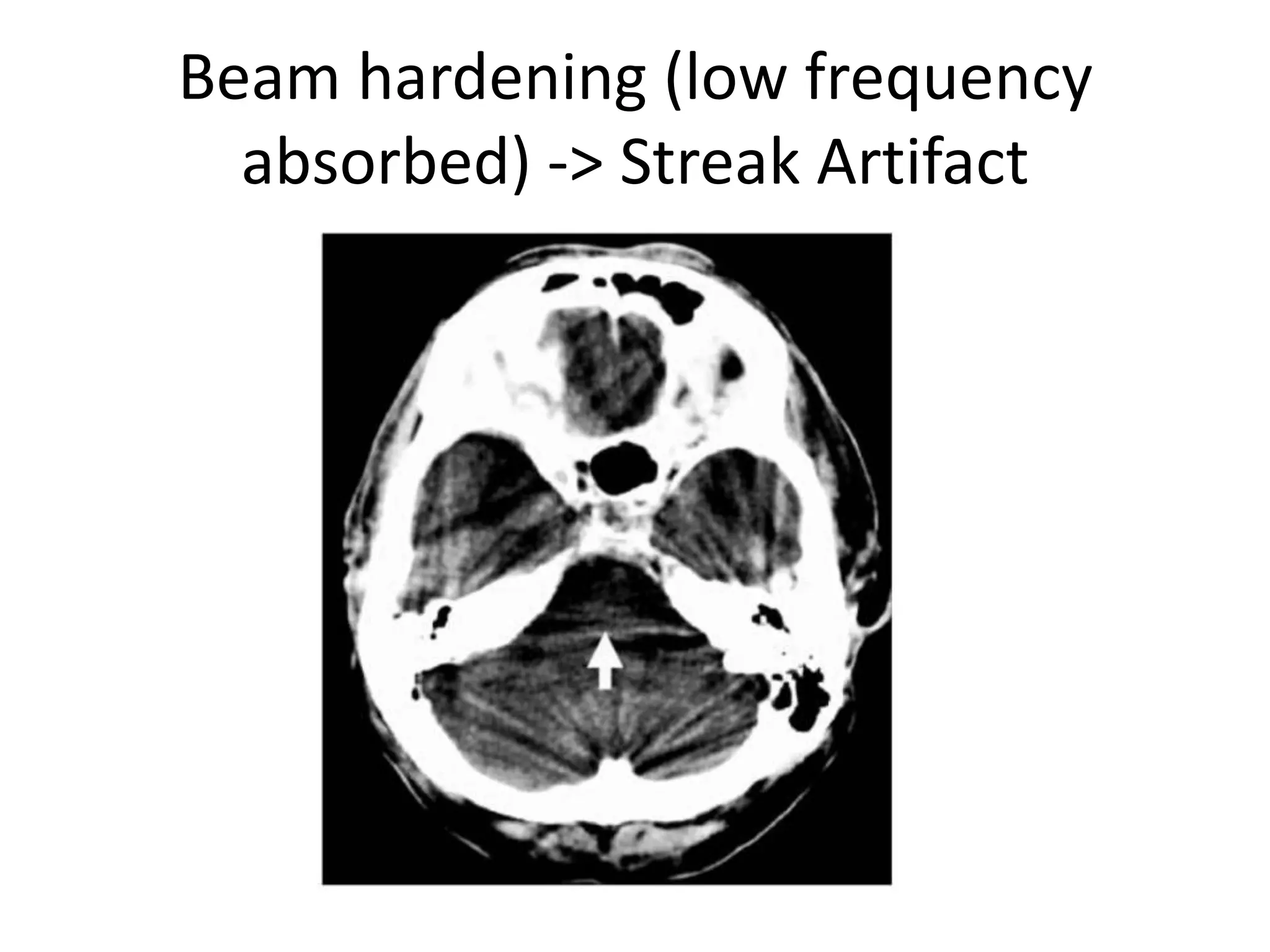 Beam hardening (low frequency absorbed) -> Streak Artifact