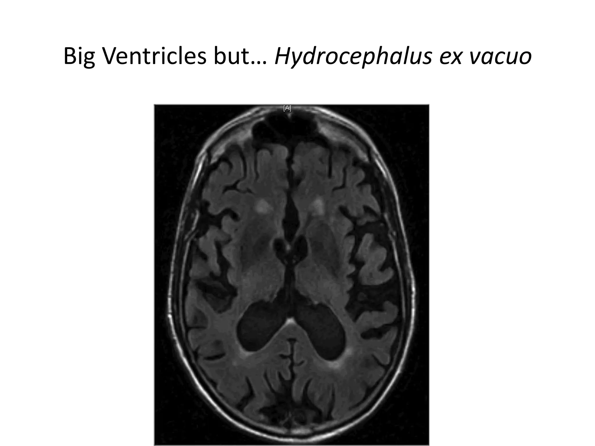 Big Ventricles but… Hydrocephalus ex vacuo