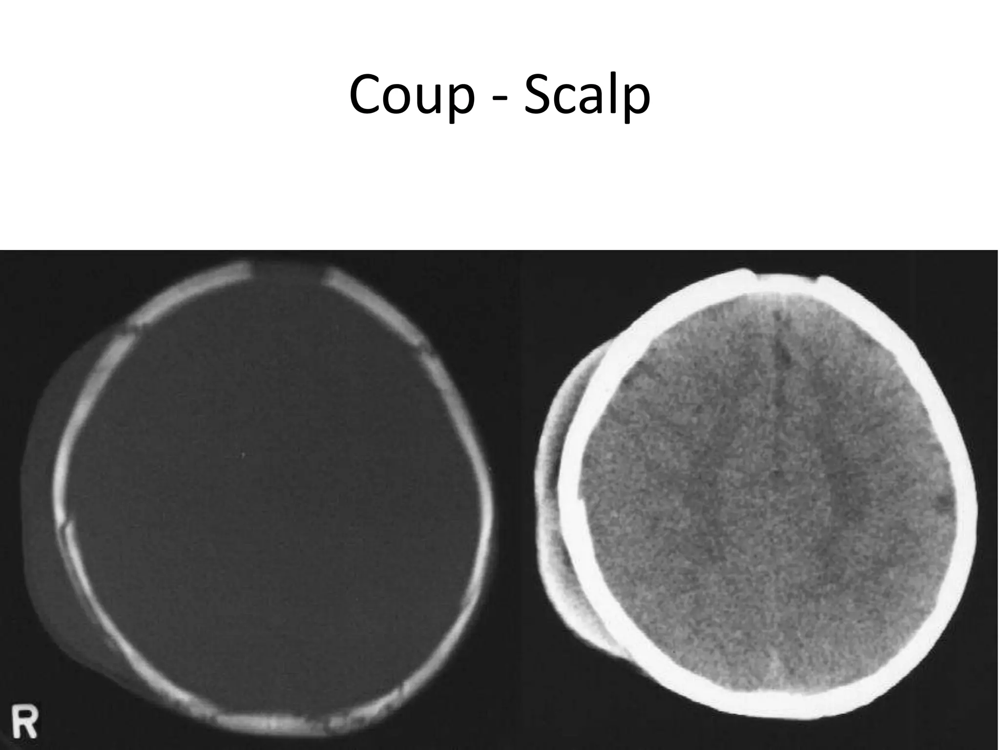 Coup - Scalp