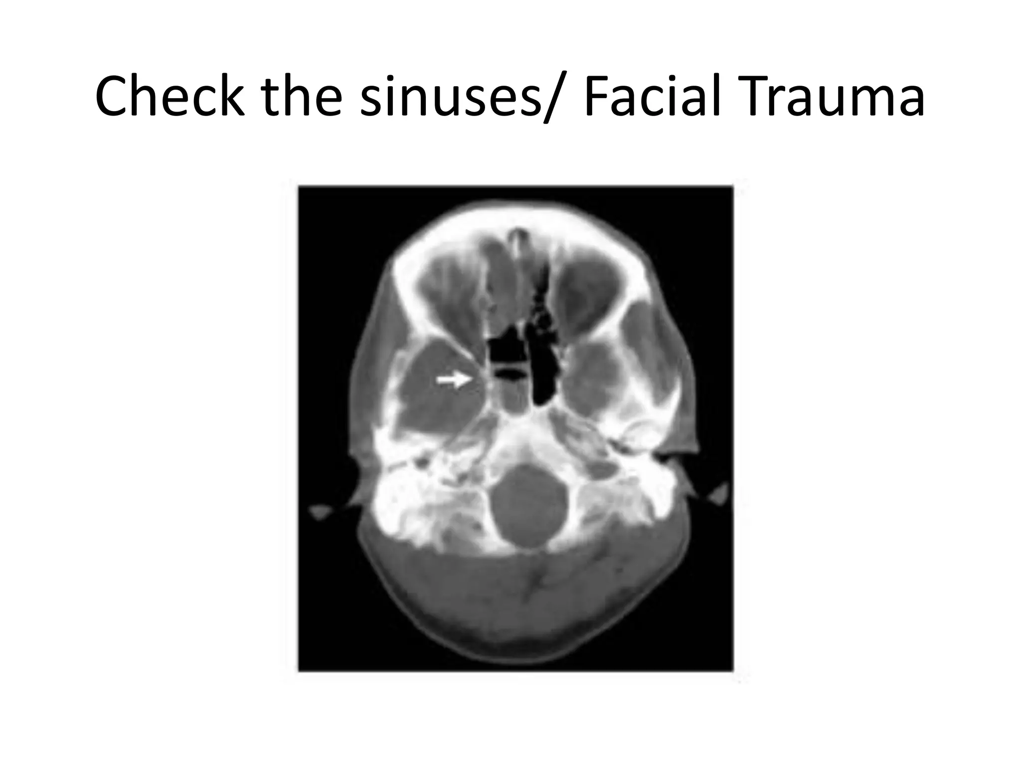 Check the sinuses/ Facial Trauma