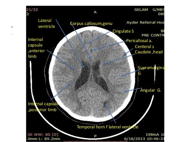 Head ct