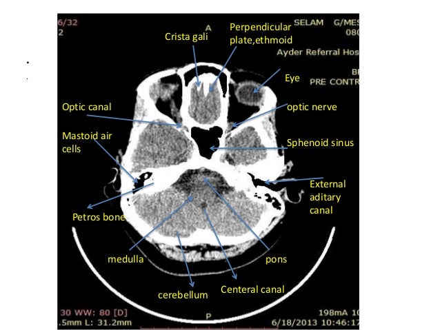 Head ct