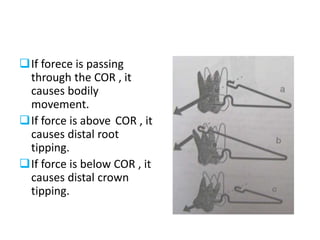 If forece is passing
through the COR , it
causes bodily
movement.
If force is above COR , it
causes distal root
tipping.
If force is below COR , it
causes distal crown
tipping.
 