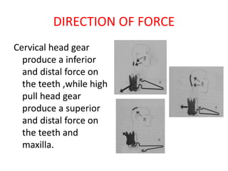 DIRECTION OF FORCE
Cervical head gear
produce a inferior
and distal force on
the teeth ,while high
pull head gear
produce a superior
and distal force on
the teeth and
maxilla.
 