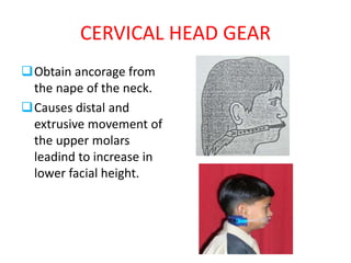 CERVICAL HEAD GEAR
Obtain ancorage from
the nape of the neck.
Causes distal and
extrusive movement of
the upper molars
leadind to increase in
lower facial height.
 