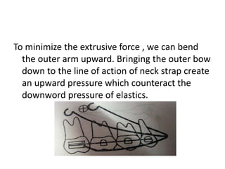To minimize the extrusive force , we can bend
the outer arm upward. Bringing the outer bow
down to the line of action of neck strap create
an upward pressure which counteract the
downword pressure of elastics.
 
