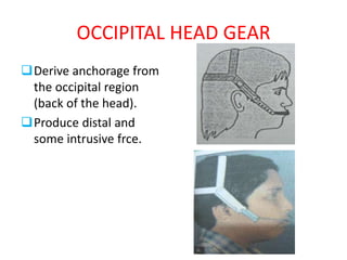 OCCIPITAL HEAD GEAR
Derive anchorage from
the occipital region
(back of the head).
Produce distal and
some intrusive frce.
 