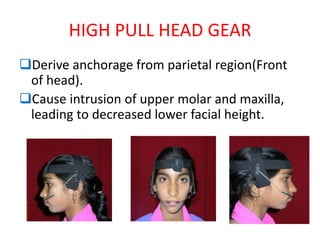 HIGH PULL HEAD GEAR
Derive anchorage from parietal region(Front
of head).
Cause intrusion of upper molar and maxilla,
leading to decreased lower facial height.
 