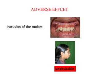 ADVERSE EFFCET
Intrusion of the molars
undesirable
 