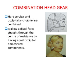 COMBINATION HEAD GEAR
Here cervical and
occipital anchorage are
combined.
It allow a distal force
straight through the
centre of resistance by
having equal occipital
and cervical
components.
 