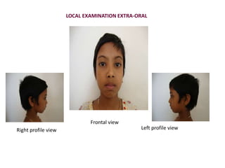 LOCAL EXAMINATION EXTRA-ORAL
Right profile view
Frontal view
Left profile view
 