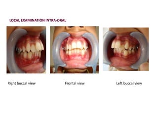 LOCAL EXAMINATION INTRA-ORAL
Frontal viewRight buccal view Left buccal view
 