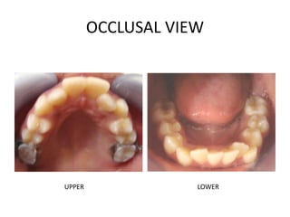 OCCLUSAL VIEW
UPPER LOWER
 