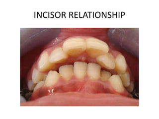 INCISOR RELATIONSHIP
 