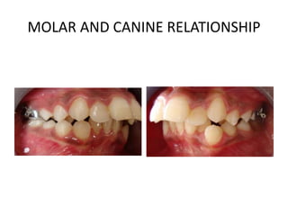 MOLAR AND CANINE RELATIONSHIP
 