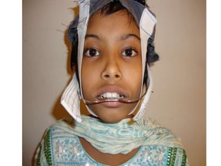 Head gear in orthodontics