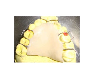 Head gear in orthodontics