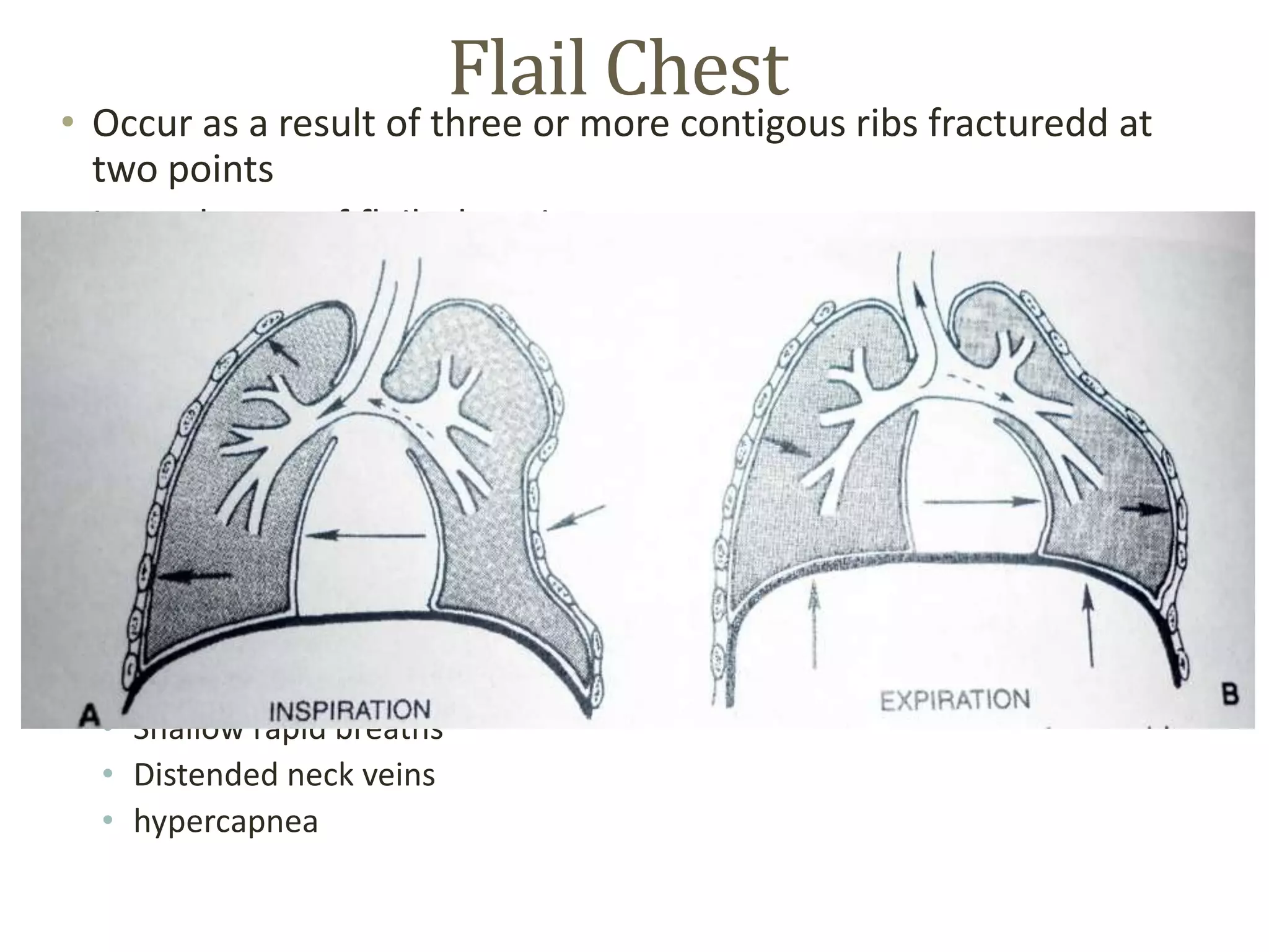 Flail Chest
• Occur as a result of three or more contigous ribs fracturedd at
two points
• Lateral type of flail chest is more common
• Anteior type occures when ribs become separated at the
costrochondral junction, with or without associated fracture of
sternum.
• The posterior type occurs whe n the posterior ribs are
fractured
• Pulmonary contusion, hemothorax and pneumothorax may be
associated with flail chest,
• Mechanical ventilation is indicated
• Tachyapnea
• Shallow rapid breaths
• Distended neck veins
• hypercapnea
 