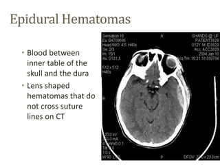 Intracranial Hematoma
• Focal areas of
hemorrhage
within the
parenchyma
 