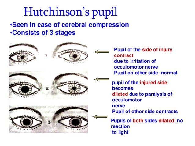 unequal pupil size following head injury unequal pupil size following head injury