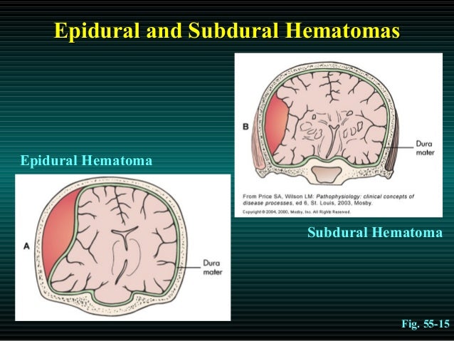 subdural hematoma blown pupil