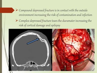  Compound depressed fracture is in contact with the outside
environment increasing the risk of contamination and infection
 Complex depressed fracture tears the duramater increasing the
risk of cortical damage and epilepsy
 