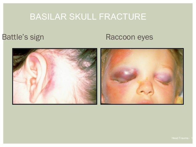 Head injuries Head injuries