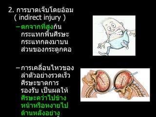 2.  การบาดเจ็บโดยอ้อม  (  indirect injury )  ตกจากที่สูง ก้นกระแทกพื้นศีรษะกระแทกลงมาบนส่วนของกระดูกคอ  การเคลื่อนไหวของลำตัวอย่างรวดเร็ว  ศีรษะขาดการรองรับ เป็นผลให้  ศีรษะคว่ำไปข้างหน้าหรือหงายไปด้านหลังอย่างรวดเร็ว  ชนิดนี้ไม่มีบาดแผลที่หนังศีรษะและกะโหลกศีรษะ 
