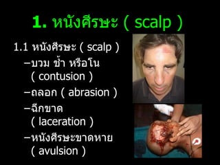 1.  หนังศีรษะ  (  scalp )   1.1  หนังศีรษะ  (  scalp )  บวม ช้ำ หรือโน  (  contusion )  ถลอก  (  abrasion )  ฉีกขาด  (  laceration )   หนังศีรษะขาดหาย  ( avulsion ) 