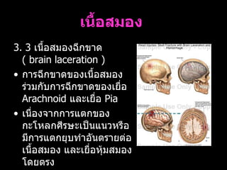 เนื้อสมอง   3. 3  เนื้อสมองฉีกขาด  (  brain laceration )  การฉีกขาดของเนื้อสมองร่วมกับการฉีกขาดของเยื่อ  Arachnoid  และเยื่อ  Pia   เนื่องจากการแตกของกะโหลกศีรษะเป็นแนวหรือมีการแตกยุบทำอันตรายต่อเนื้อสมอง และเยื่อหุ้มสมองโดยตรง  