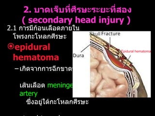 2.  บาดเจ็บที่ศีรษะระยะที่สอง  (  secondary head injury )   2.1  การมีก้อนเลือดภายในโพรงกะโหลกศีรษะ   epidural   hematoma   เกิดจากการฉีกขาดของ  เส้นเลือด  meningeal artery   ซึ่งอยู่ใต้กะโหลกศีรษะ   tend to enlarge rapidly   Epidural hematomas  มักจะ  เกิดร่วมกับ   skull fracture   skull Epidural hematoma Skull 
