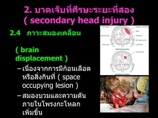 2.  บาดเจ็บที่ศีรษะระยะที่สอง  (  secondary head injury ) 2.4    ภาวะสมองเคลื่อน   ( brain displacement )   เนื่องจากการมีก้อนเลือดหรือสิ่งกินที่  (  space occupying lesion )  สมองบวมและความดันภายในโพรงกะโหลกเพิ่มขึ้น  ทำให้เบียดเนื้อสมองจนกระทั่งเคลื่อนสู่ช่องเปิดภายในและภายนอกกะโหลกศีรษะ  