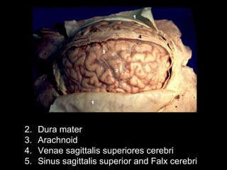 Dura mater  Arachnoid  Venae sagittalis superiores cerebri  Sinus sagittalis superior and Falx cerebri 