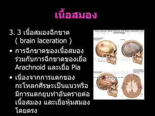 เนื้อสมอง   <ul><li>3. 3  เนื้อสมองฉีกขาด  (  brain laceration )  </li></ul><ul><li>การฉีกขาดของเนื้อสมองร่วมกับการฉีกขาดข...